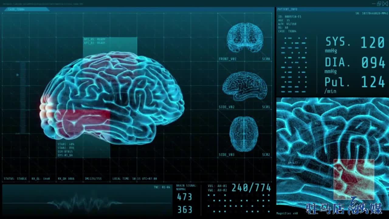 科学认知颅内的“不定时炸弹”脑动脉瘤